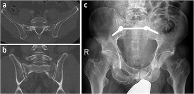 Clinical and Patient-Related Outcome After Stabilization of Dorsal Pelvic Ring Fractures: A Retrospective Study Comparing Transiliac Fixator (TIFI) and Spinopelvic Fixation (SPF)